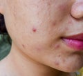 Acne , black spots and scars oily on face Royalty Free Stock Photo