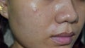 Acne , black spots and scars oily on face of Asian young woman Royalty Free Stock Photo