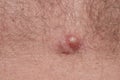 Acne on body skin, dermatological disease acne, closeup