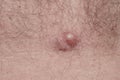 Acne on body skin, dermatological disease acne, closeup