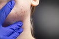 Acne on the chin: demodecosis tick on the skin of a girl`s face. Patient at the appointment of a dermatologist. Problem skin and Royalty Free Stock Photo
