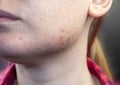 Acne on the chin: demodecosis tick on the skin of a girl`s face. Patient at the appointment of a dermatologist. Problem skin and