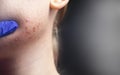 Acne on the chin: demodecosis tick on the skin of a girl`s face. Patient at the appointment of a dermatologist. Problem skin and Royalty Free Stock Photo