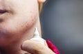 Acne on the chin: demodecosis tick on the skin of a girl`s face. Patient at the appointment of a dermatologist. Problem skin and Royalty Free Stock Photo