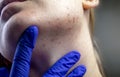 Acne on the chin: demodecosis tick on the skin of a girl`s face. Patient at the appointment of a dermatologist. Problem skin and