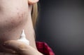Acne on the chin: demodecosis tick on the skin of a girl`s face. Patient at the appointment of a dermatologist. Problem skin and