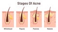 Acne development stages. Inflamed skin pimples. Plugged hair follicles