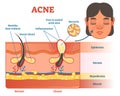 Acne diagram illustration with hair, pimple, skin layers and structure. Female face alongside. Educational medical informat Royalty Free Stock Photo