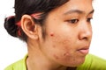 Acne on face girl