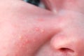 Acne on the face of a newborn child, close-up. Macro photos of skin defects in the baby