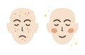 Acne face treatment concept with two different faces before and after. Acne skin problem. Acne scars. Anti acne cosmetic