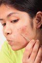 Acne on face women Royalty Free Stock Photo