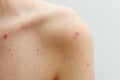 Acne female body with skin in pimples Royalty Free Stock Photo