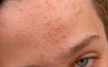 Acne forehead Royalty Free Stock Photo