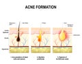 Acne formation. human skin. Royalty Free Stock Photo