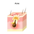 Acne Formation. Papule and pimple Royalty Free Stock Photo