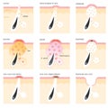 Acne formation process Royalty Free Stock Photo