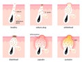 Acne formation process skin layer. types of acne. Healthy skin, sebum plug, whitehead, blackhead, Papules, and Pustules.skin care