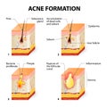 Acne formation Royalty Free Stock Photo