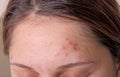 Acne on the girl's forehead