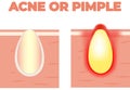 Acne growing with a lot of pus and giving a red hurting alert vector. Bron or pimple on the skin with yellow pus. Pus growing