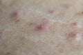 Acne on the human skin that is caused by the cover