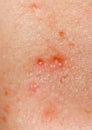 Acne on human skin Royalty Free Stock Photo