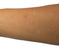 Acne on a Male Arm Royalty Free Stock Photo