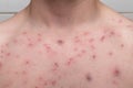 Acne on a chest. result of using steroids and anabolics Royalty Free Stock Photo