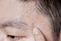Acne Mechanica or sports-induced acne or whiteheads or mild acne at forehead Royalty Free Stock Photo