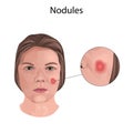 Acne. Nodules. Young woman face with skin inflammation. Close-up view.