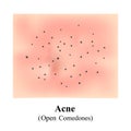 Acne, Open Comedones. Skin with blackheads. Black spots. Acne on the skin. Infographics. Vector illustration.