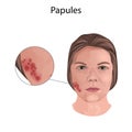 Acne. Papules. Young woman face with skin inflammation. Close-up view.