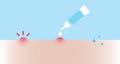 Acne pimple treatment for papule vector illustration on sky blue background.