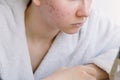 Acne. Portrait of a teenager girl with problem skin. Problem skin care Royalty Free Stock Photo