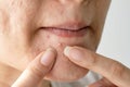 Acne pus, Close up photo of acne prone skin, Woman squeezing her pimple. Royalty Free Stock Photo