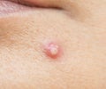 Acne pus on face