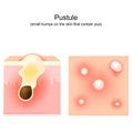 Acne. Pustule. Cross-section of a human skin. Hair follicle with pus