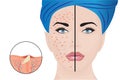 Acne pustules on a woman face and a treatment result
