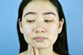 Acne scar skin facial problem, Asian woman annoy and bored about hormonal pimples. Royalty Free Stock Photo