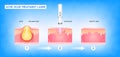 Acne scar vascular laser treatment. Inflammation associated with pimples. The structure of the skin acne scar. Medical beauty skin