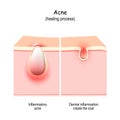 Acne scars. Abnormal healing of pimple