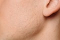 Acne scars on the face Royalty Free Stock Photo