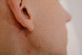 Acne scars on the face Royalty Free Stock Photo