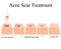 Acne scars. Laser scar atrophic treatment. The anatomical structure of the skin with acne. Vector illustration on