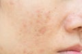 Acne scars and pores. Dark spots. Wrinkles Royalty Free Stock Photo