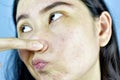 Acne skin problem, Asian woman annoy and bored about hormonal pimples.