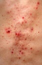 Acne Skin Texture Royalty Free Stock Photo