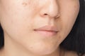 Acne spots Royalty Free Stock Photo