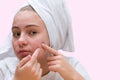 Acne. teenage girl squeezing out pimples on her face Royalty Free Stock Photo